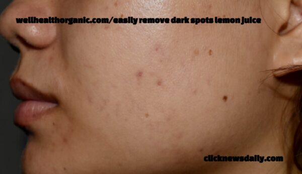 wellhealthorganic.com/easily remove dark spots lemon juice